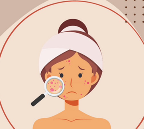 КАК ИЗБАВИТЬСЯ ОТ ПРЫЩЕЙ